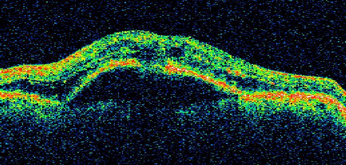 the-role-of-fluid-in-wet-age-related-macular-degeneration-wet-amd-amd